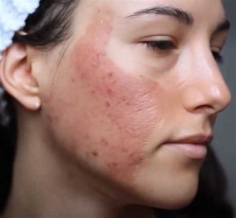 Kimyasal Peeling: Güvenlik ve Etkinlik Arasındaki İnce Çizgi